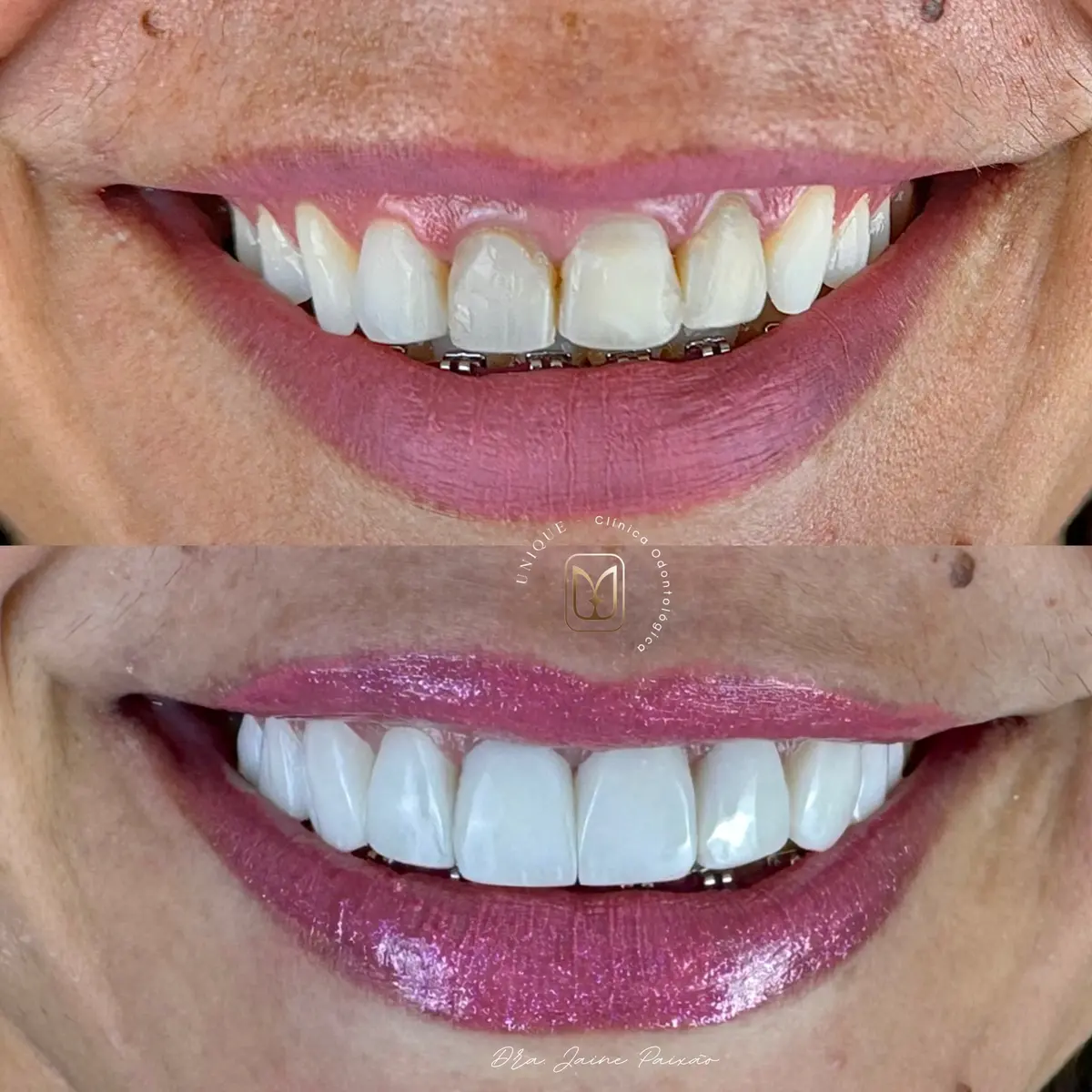 Antes e depois de transformação do sorriso