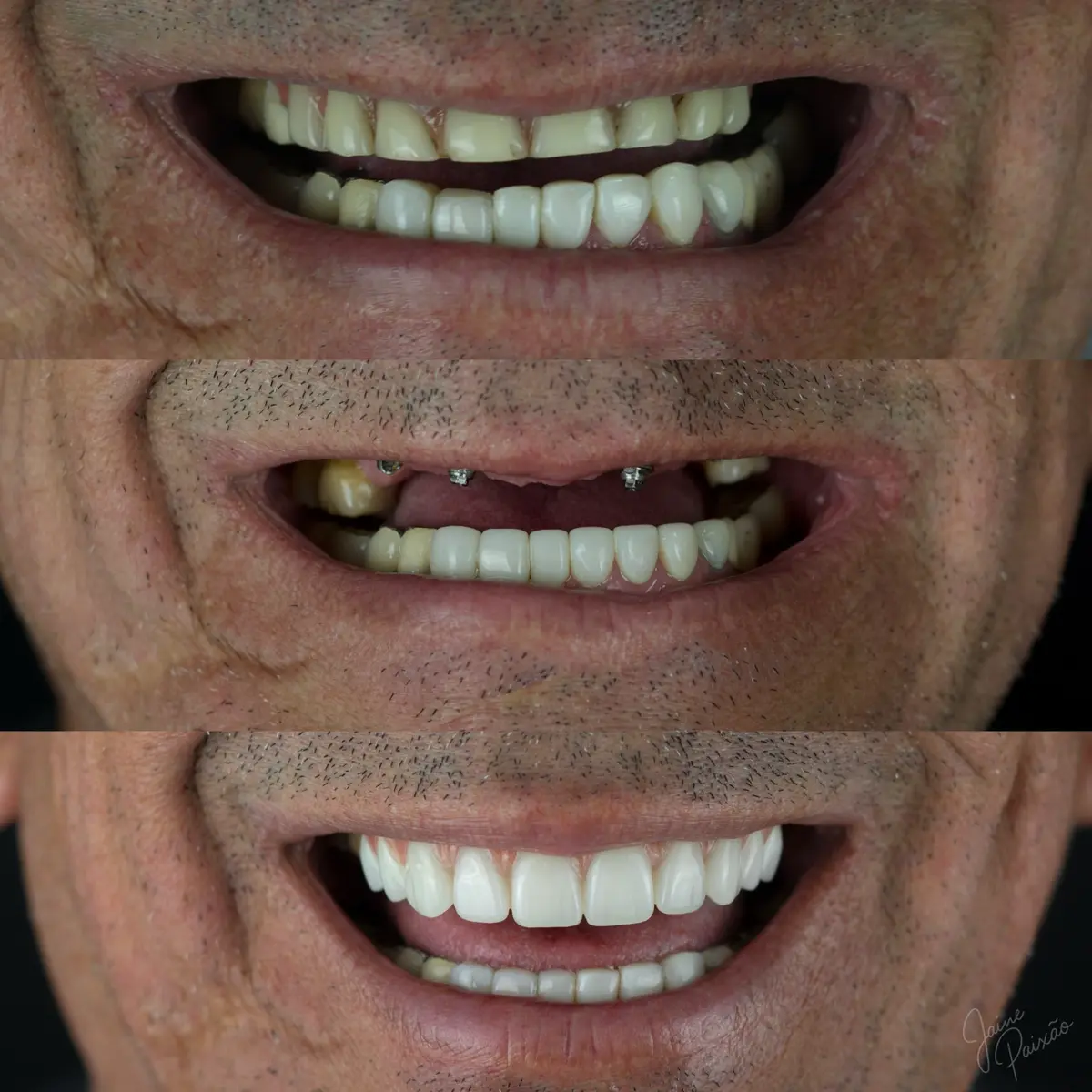Antes, etapa de implantes e resultado final