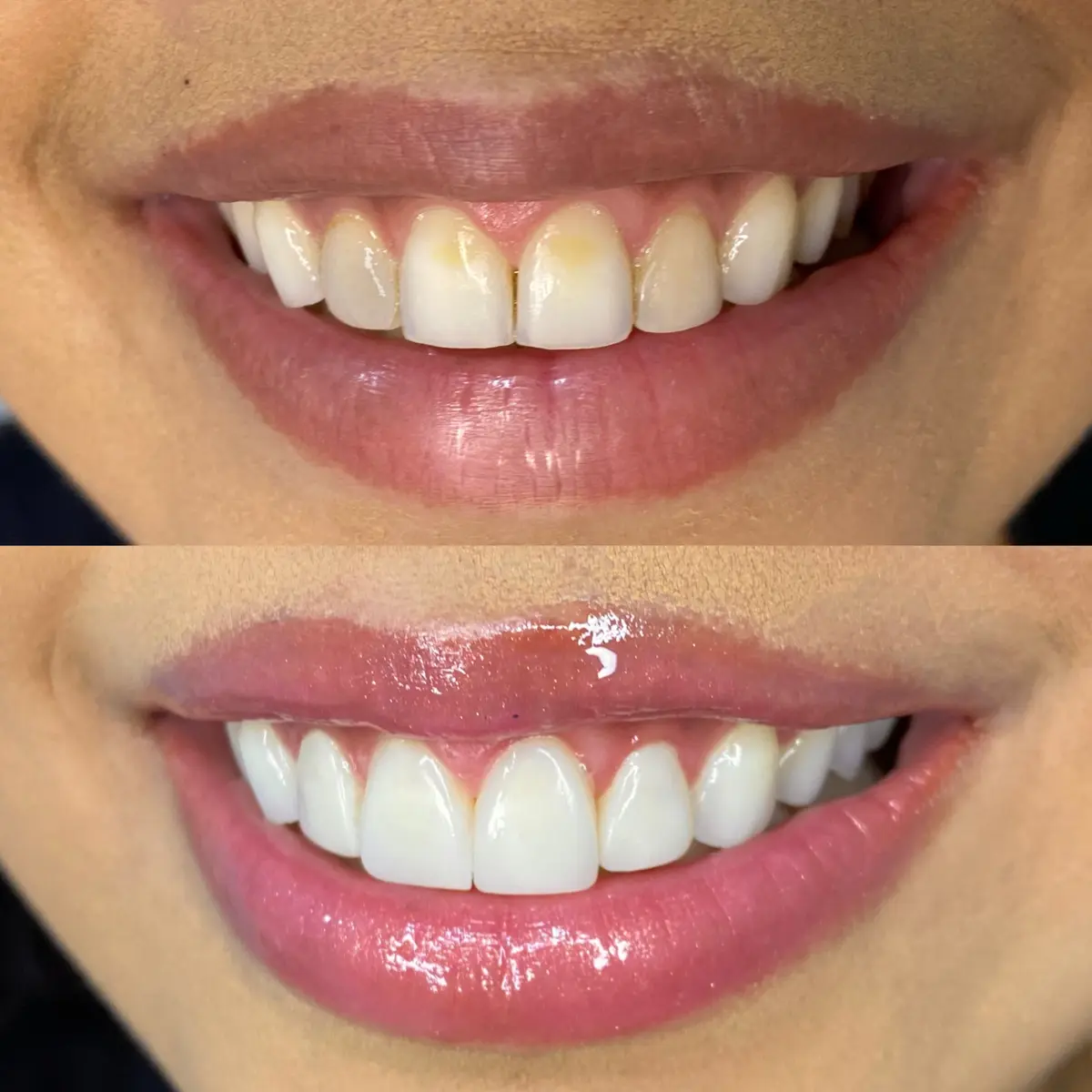 Antes e depois de lentes em resina