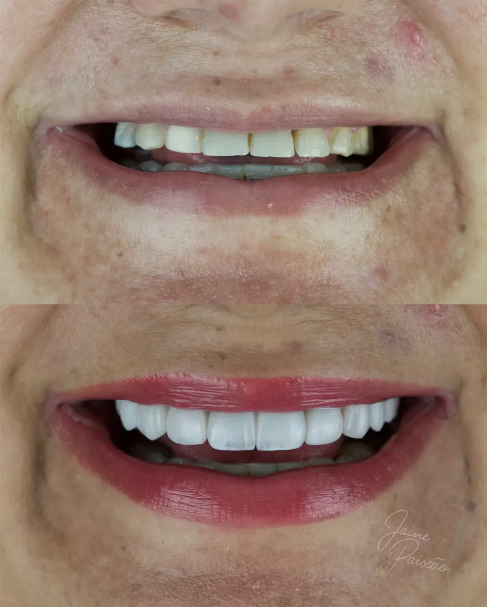Antes e depois de reabilitação oral